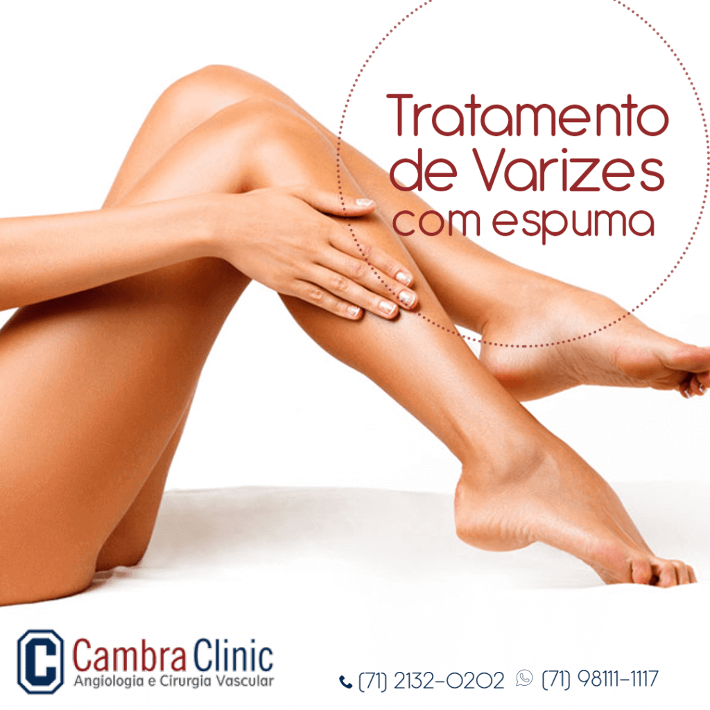 tratamento de varizes com espuma